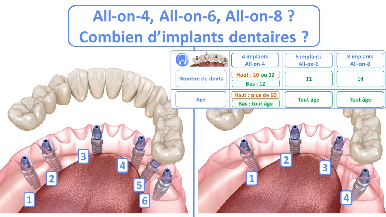 ALL ON 4 - Combien d'implants dentaires par mâchoire ?