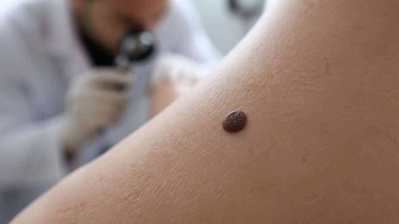 découvrez quand il est important de consulter un dermatologue pour un grain de beauté en relief afin de prévenir tout risque et assurer une peau saine.