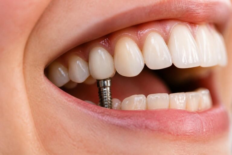 découvrez tout ce qu'il faut savoir sur la prothèse dentaire sur implant pour faire un choix éclairé et retrouver un sourire naturel et fonctionnel.