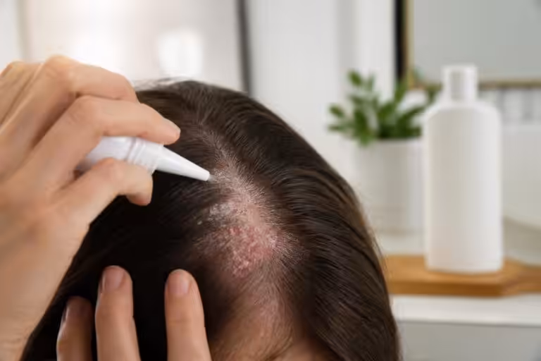 découvrez des solutions efficaces pour traiter le psoriasis du cuir chevelu et soulager les démangeaisons, avec des conseils adaptés et des traitements recommandés.