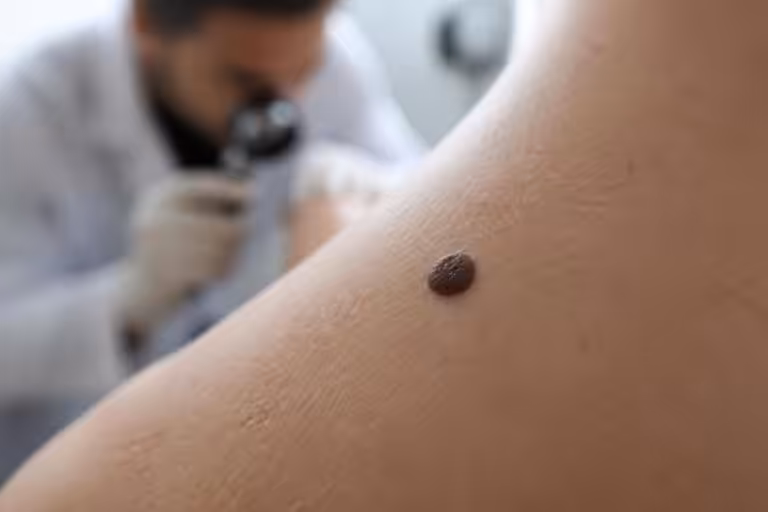 découvrez quand il est important de consulter un dermatologue pour un grain de beauté en relief afin de prévenir tout risque et assurer une peau saine.