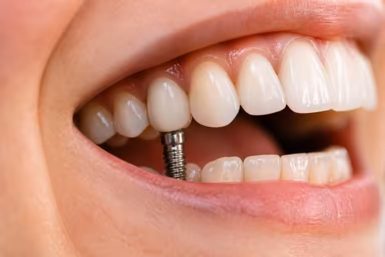 découvrez tout ce qu'il faut savoir sur la prothèse dentaire sur implant pour faire un choix éclairé et retrouver un sourire naturel et fonctionnel.